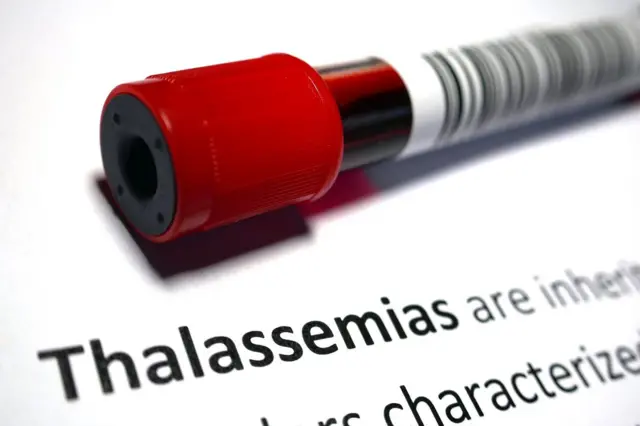 বিশ্বের অধিকাংশ দেশের চেয়ে বাংলাদেশে থ্যালাসেমিয়ার বাহকের হার বেশি