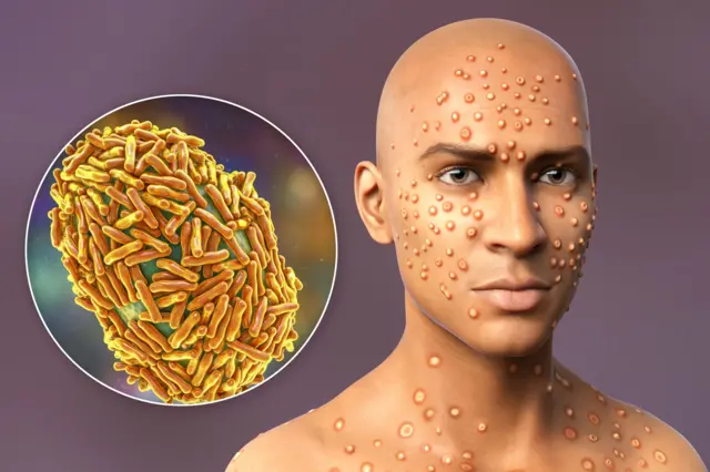 ਮੰਕੀ ਪਾਕਸ ਦਾ ਵਾਇਰਸ ਅਤੇ ਮਰੀਜ਼ ਦਾ ਸਕੈਚ