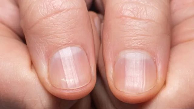 Mbọ aka nwere ntụpọ ọcha