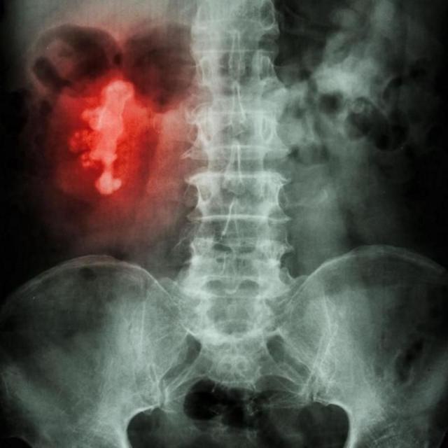 சிறுநீரக கற்கள் முதல் உமிழ்நீர் கற்கள் வரை