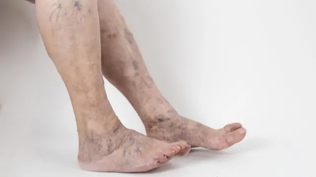 సిరల వాపు