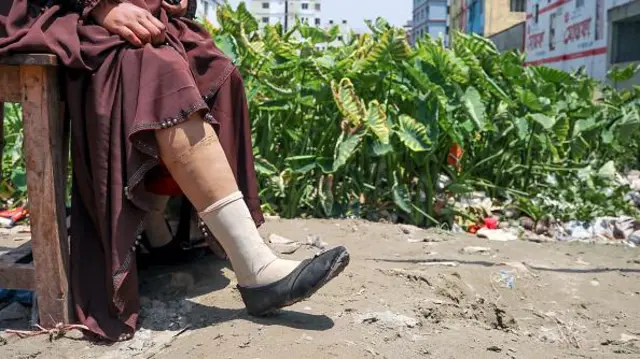 কৃত্রিম পা নিয়ে এক আহত শ্রমিক।