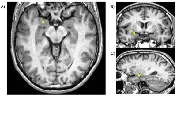 Localisation de l'amygdale dans les images de résonance magnétique structurelle (indiquée par les flèches jaunes). A) coupe axiale ; B) coupe coronale et C) coupe sagittale.