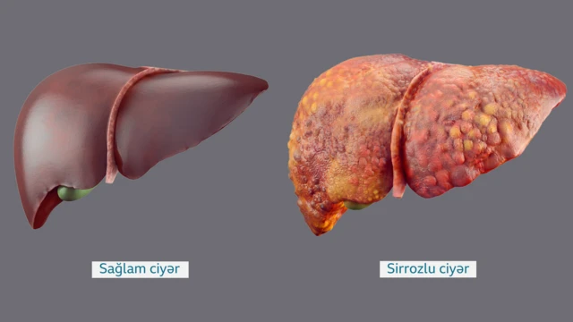Sağlam və sirrozlu ciyərin fərqi