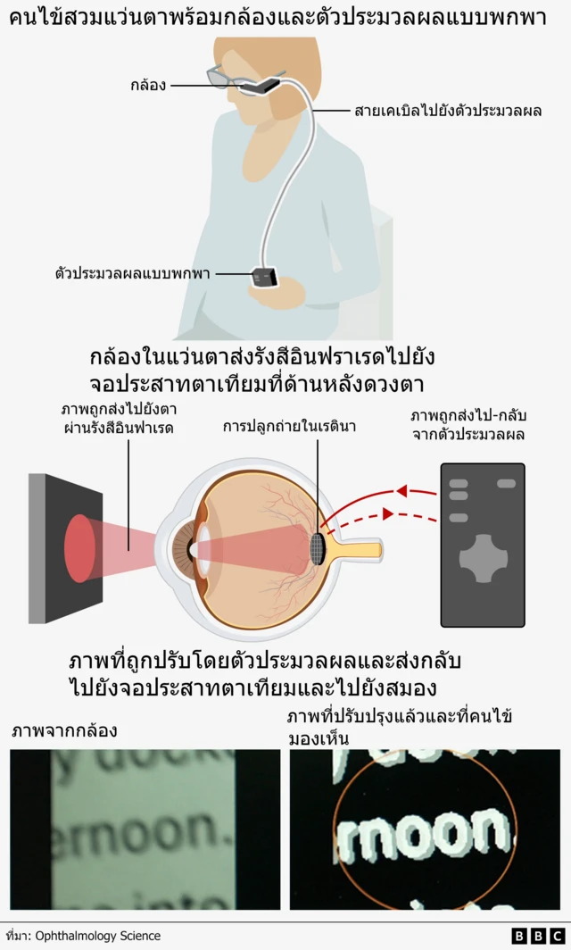  กราฟิกแสดงการทำงานของเทคโนโลยีนี้หลังการผ่าตัดปลูกถ่ายอุปกรณ์พิเศษ