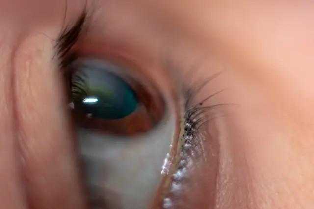 కళ్ల కలకలు