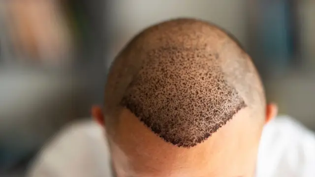 transplantasi rambut