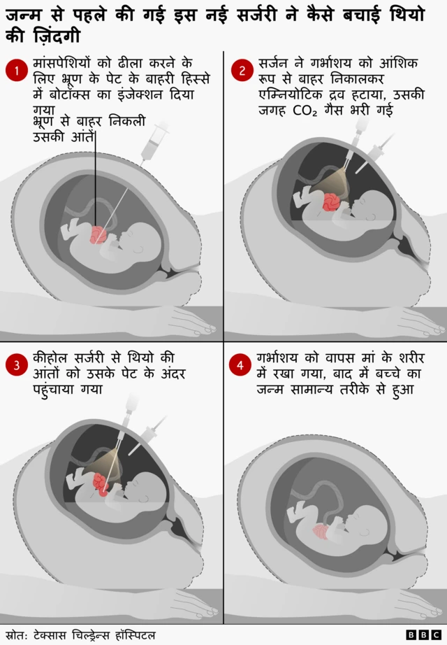 इस इंफ़ोग्राफ़िक की मदद से प्रसवपूर्व सर्जरी के चार चरणों को समझें 