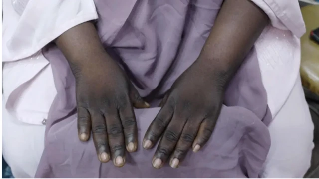 Aworan ọwọ to dudu latari ipara ti ki i bo ika ọwọ