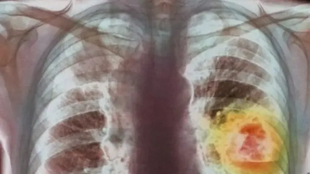 ફેફસાં, કેન્સર, આરોગ્ય, ગુજરાત, ભારત 