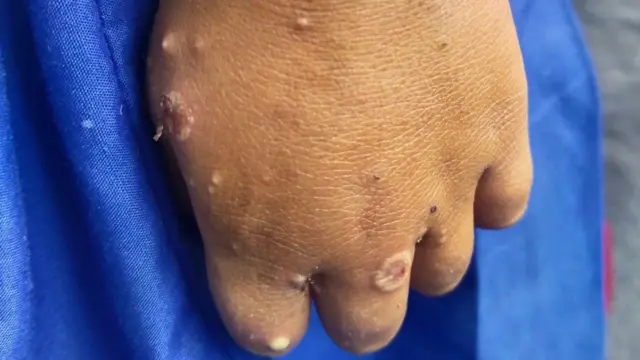 ကရင်နီက စစ်ဘေးရှောင်ကလေးရဲ့လက်