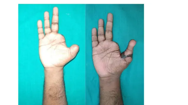 இழந்தது கட்டை விரலை, கிடைத்தது கால் விரல்