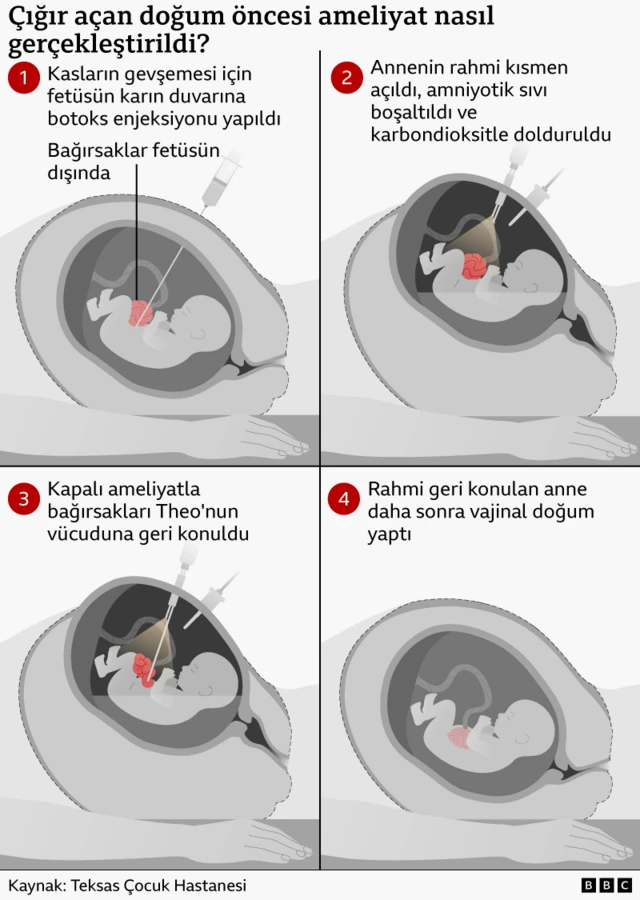 Dört aşamalı bir doğum öncesi ameliyatı gösteren infografik. Fetüsün karın duvarına kasları gevşetmek için Botox enjeksiyonu yapılır, cerrahlar rahmi geçici olarak açar ve kapalı ameliyat yöntemiyle fetüsün bağırsaklarını vücudun içine geri taşır, ardından rahmi tekrar kapatır; bu sayede sağlıklı bebek doğal yolla doğana kadar gebelik devam eder.