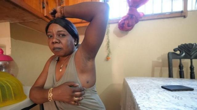 Une Dame montrant sa cicatrice laissée par un tir de pistolet