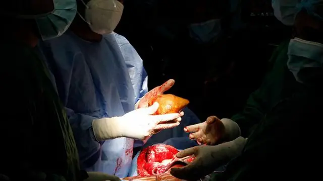 “ස්කෑන් වලින් අපි අඳුන ගත්තා මෙච්චර ලොකු ගලක් තියනවා කියලා. ඒ වගේම අපිට මේ ශල්යකර්මය සිදුකරන්න සුදානම් වෙන්නම සති දෙකක් ගතවුණා."