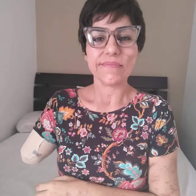 Mulher com um dos braços amputados sentada na cama