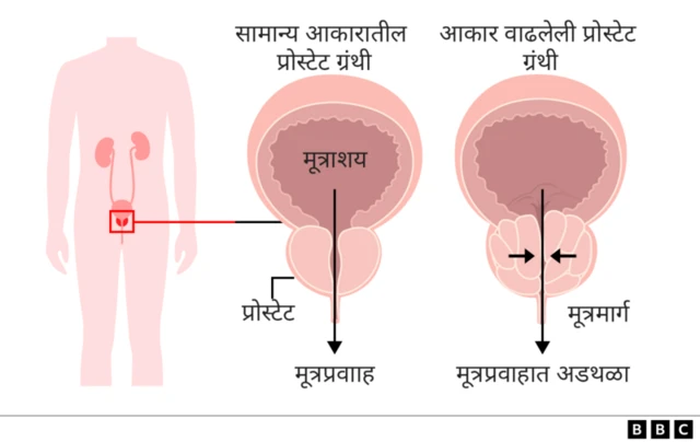 प्रोस्टेट ग्रंथी