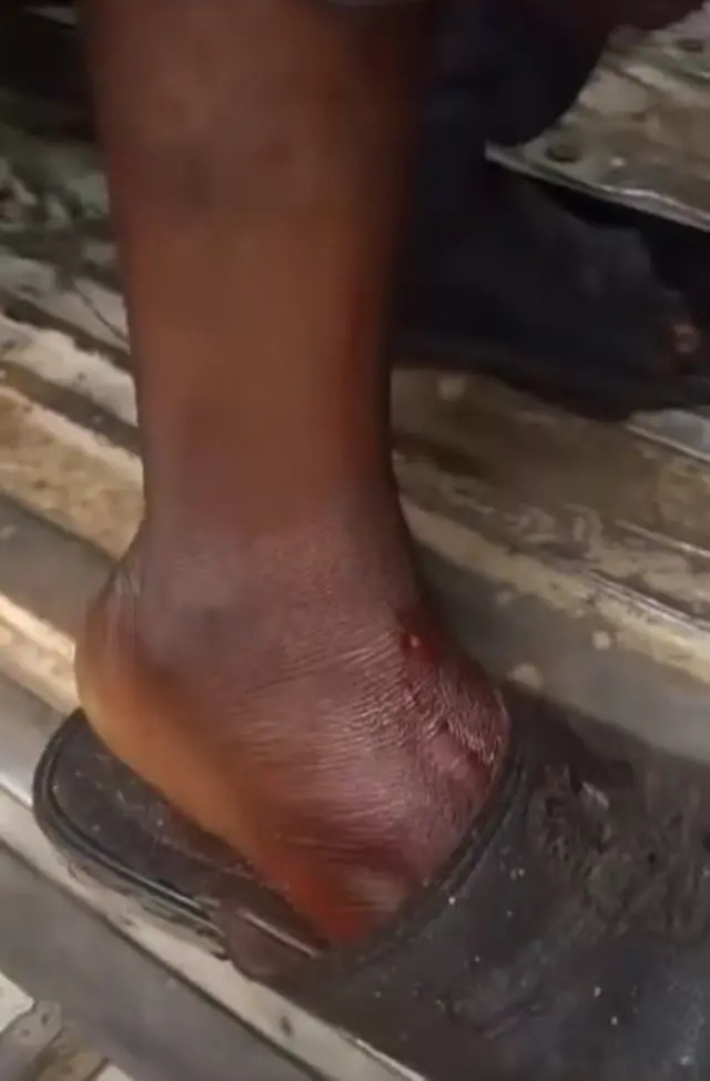 Ọkan lara awọn eeyan to farapa fi oju ọgbẹ rẹ han