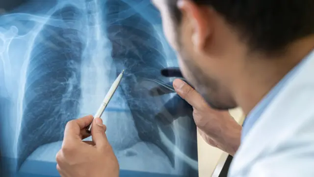 تُستخدم الأشعة للتحقق من إصابة الرئة