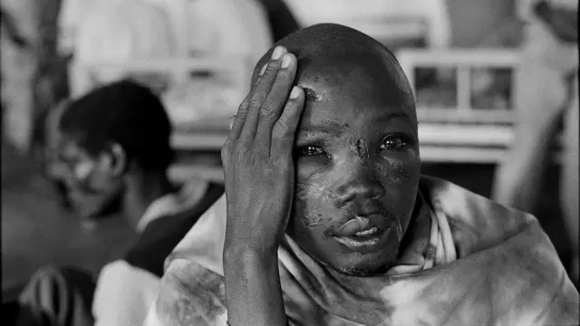 በጅምላ ጭፍጨፋው አካሉ ላይ ጉዳት የደረሰበት ሩዋንዳዊ