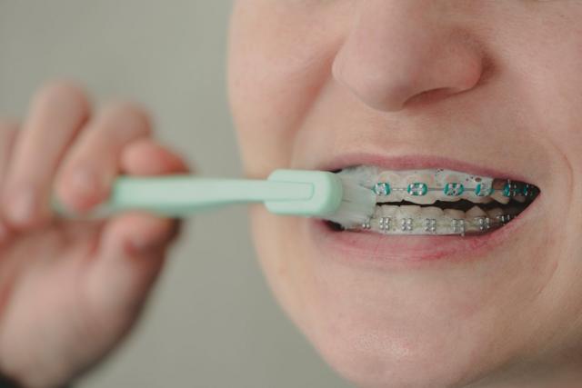 Una mujer con frenos ortodónticos se cepilla los dientes