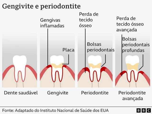 Um gráfico mostrando como a doença gengival se desenvolve em dentes saudáveis