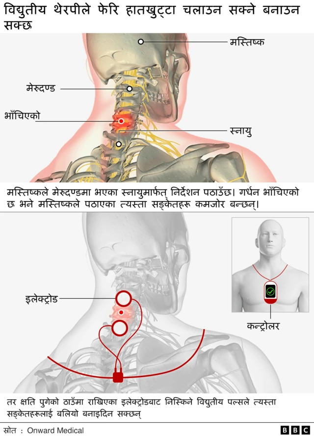 गर्धन भाँचिएको अवस्था