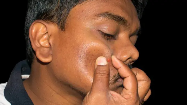 మొటిమలు, ఆరోగ్యం, చర్మవ్యాధి