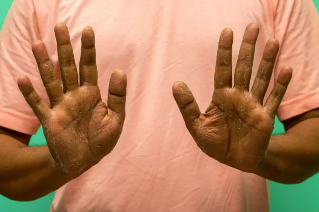 Tinea Manuum: तुमच्याही हातापायावर, बोटांवर, नखांजवळ चट्टे येतात? खाजही सुटते? मग हे वाचा bbc marathi health आरोग्य बीबीसी मराठी