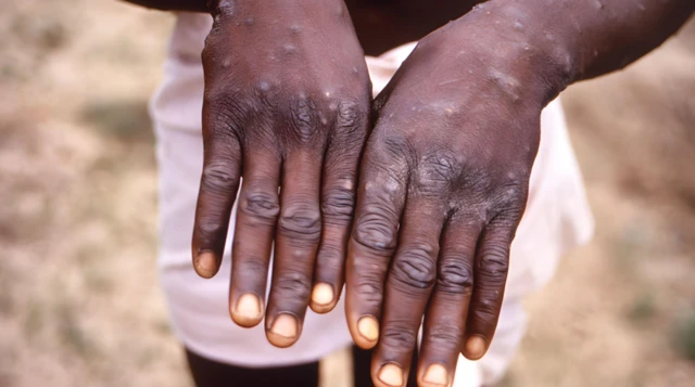 የዝንጀሮ ፈንጣጣ