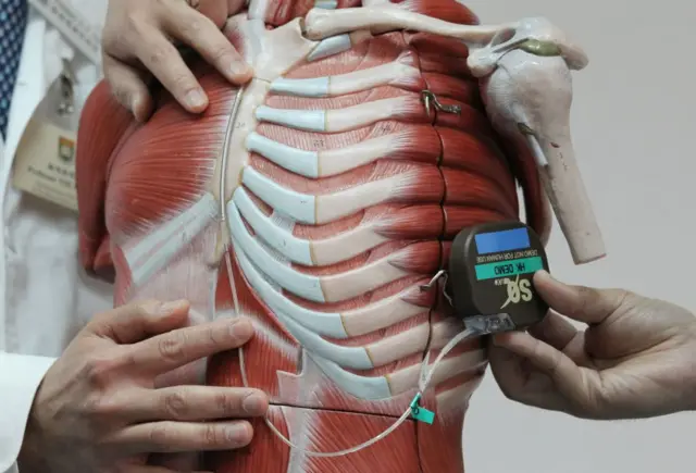 Desfibrilador implantable