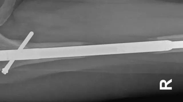 Photo caption: Elaine's right leg showed a lack of bone growth, requiring further treatment
ภาพขาขวาของเอเลนที่แสดงให้เห็นว่า กระดูกขาดการเจริญเติบโต ซึ่งจําเป็นต้องได้รับการรักษาเพิ่มเติม
