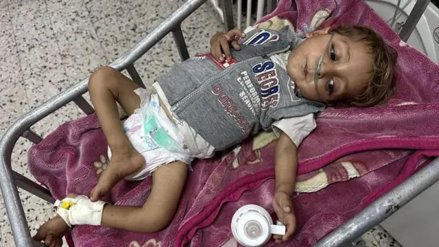 MIles de niños en Gaza sufren desnutrición, según organismos de la ONU.