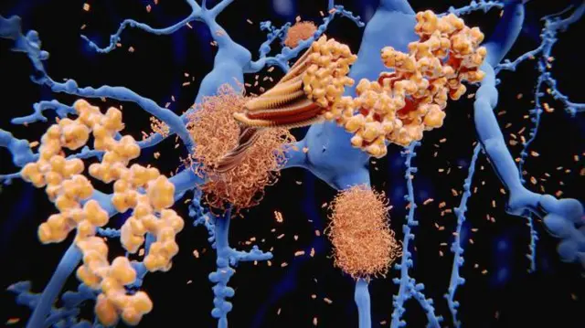 A deposição da proteína beta-amiloide nos neurônios