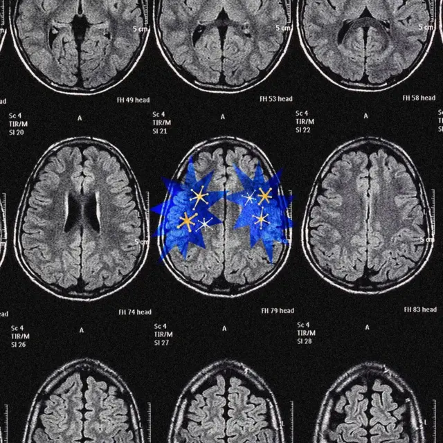 Yan yana duran siyah beyaz beyin filmleri