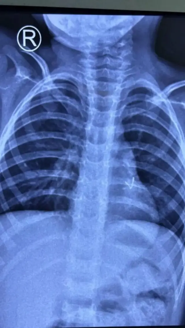  குழந்தையின் நுரையீரலில் சிக்கியிருந்த LED விளக்கு