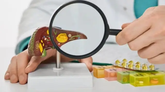 लिवर कैंसर संबंधी तस्वीर