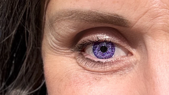 Primer plano del rostro de una mujer. Su ojo tiene una prótesis morada. El iris es de color púrpura amatista.