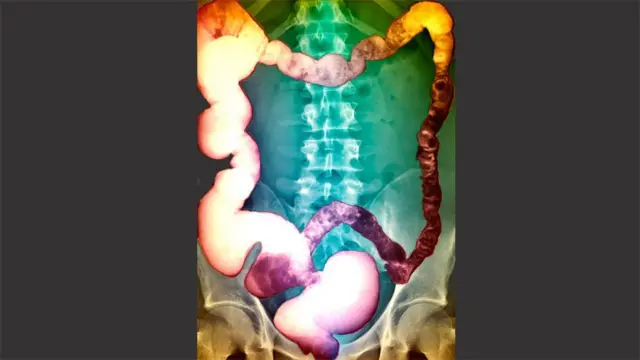 ኣስታት 50 ሚእታዊት ቀልቀል ደቂ ሰባት ባክተርያ እዩ