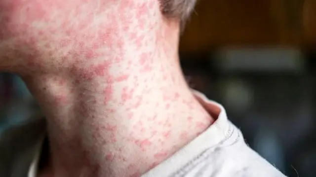 A person with rash