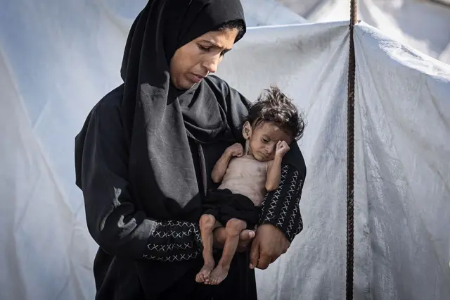 অপুষ্টিতে মৃত্যুর সংখ্যা বাড়ছে