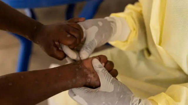 Maymun çiçeği (mpox) virüsü ve belirtileri nedir, nasıl bulaşır, tedavisi var mı? - BBC News Türkçe