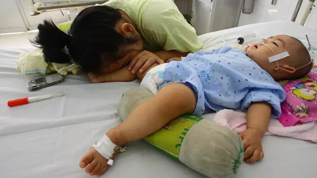 Wabah penyakit tangan, kaki, dan mulut di Vietnam