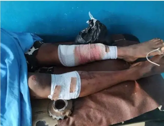 Ẹsẹ meji ti wọn fi bandeji we a lori ibusun