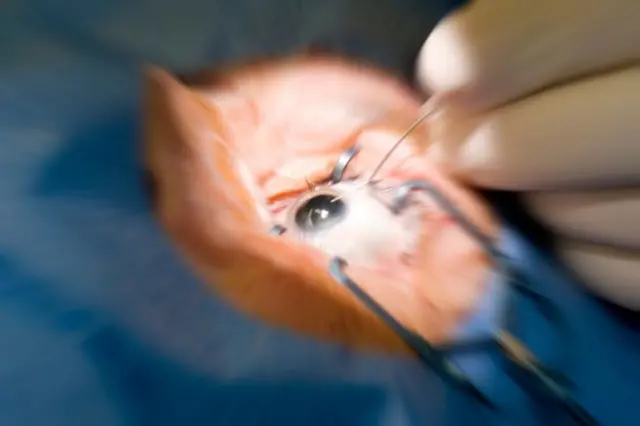 லேசிக் கண் அறுவை சிகிச்சை யாரெல்லாம் செய்துகொள்ளலாம்? 8 எளிய கேள்வி-பதில்கள்