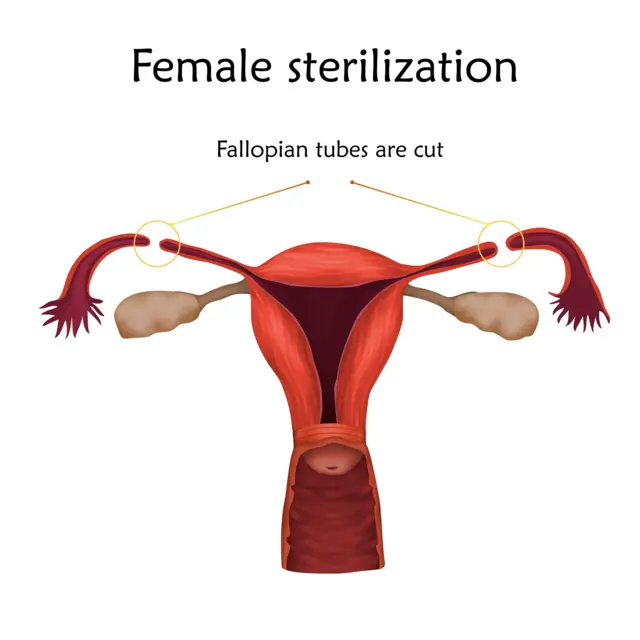 Diagram wey show female sterilization