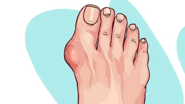 गाऊटच्या