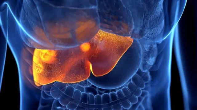 L'insuffisance hépatique est l'une des principales conséquences de l'abus de paracétamol.