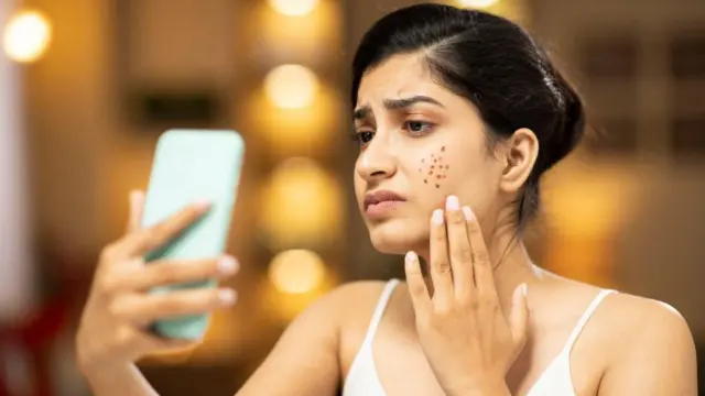 మొటిమలు, ఆరోగ్యం, చర్మవ్యాధి