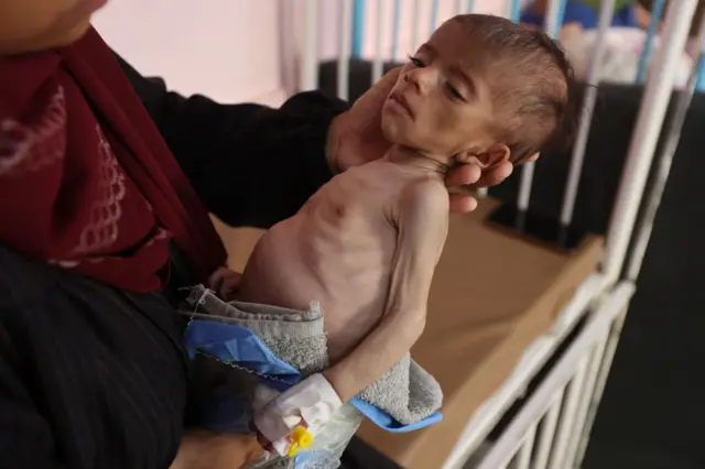 امرأة فلسطينية تحمل ابنتها وتين أبو عمو، البالغة من العمر خمسة أشهر، والتي تعاني من سوء التغذية،24 يوليو/تموز 2025.